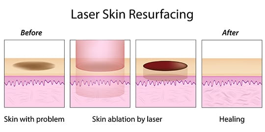 Fractional Laser Skin Treatment