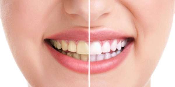 Dental Veneers Treatments – Montreal International Clinic