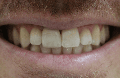 Dental treatments dubai - Dental implants Denatla veneers