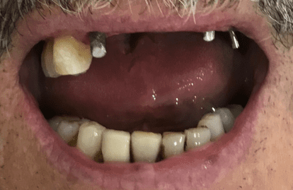 Dental treatments dubai - Dental implants Denatla veneers