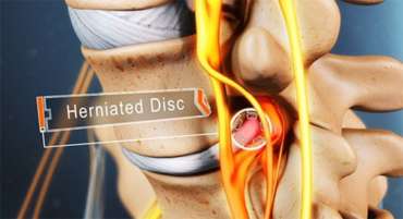 Herniated Disc Treatments | Herniated Disc in Neck | Herniate Disc