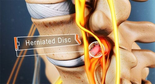 Herniated Disc Treatments