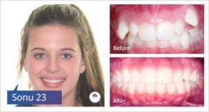 braces-case-study-3