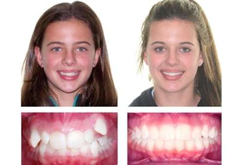 braces-case-study-lady