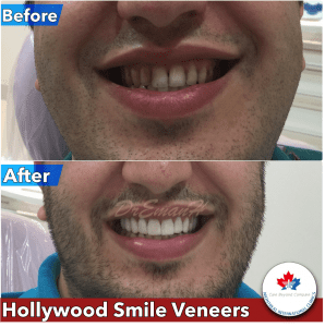 collage-veneers-Montreal-Clinic-298x300