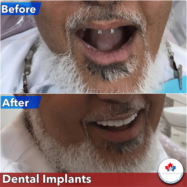 Dental Implants in Dubai | Same Day Dental Implants Dubai Procedure