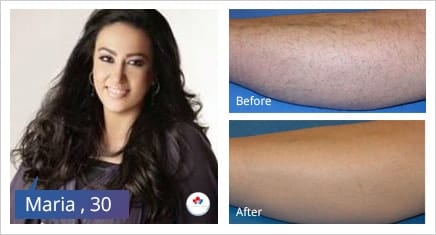 laser hair removal dubai