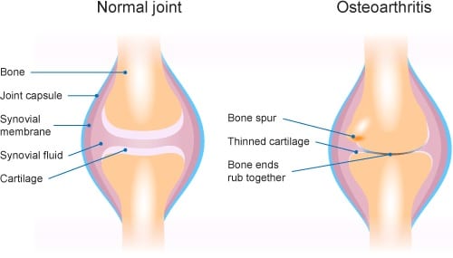 osteoarthritis-treatments