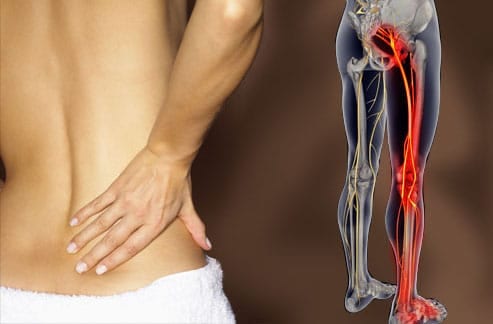 sciatica- Montreal International Clinic Dubai