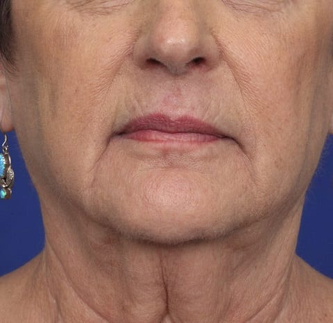 facelift before1