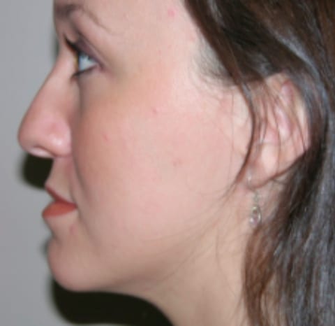 rhinoplastry3