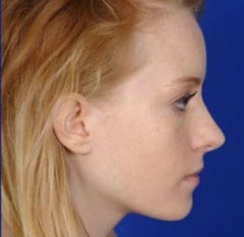 rhinoplasty1