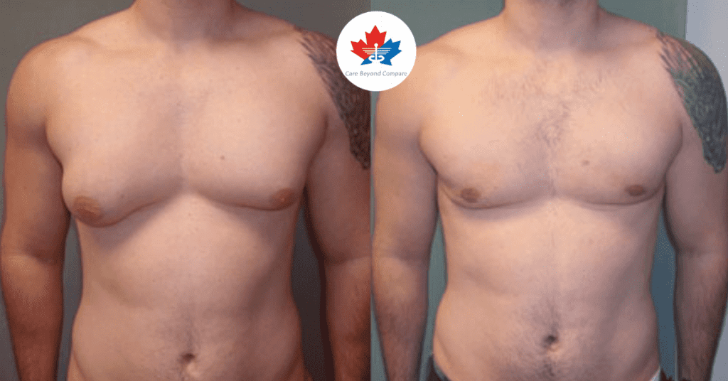 Missing Out Because of Man Boobs? Gynecomastia and Its Cure